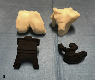 Postoperative mechanical alignment analysis of total knee replacement patients operated with 3D printed patient specific instruments: A Prospective Cohort Study