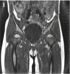 Evaluation of cartilage coverage with magnetic resonance imaging in residual dysplasia and its impact on surgical timing