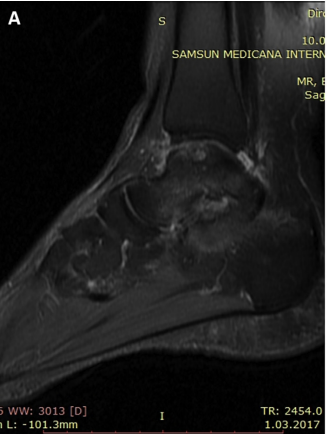 One step treatment of talus osteochondral lesions with microfracture and cell free hyaluronic acid based scaffold combination