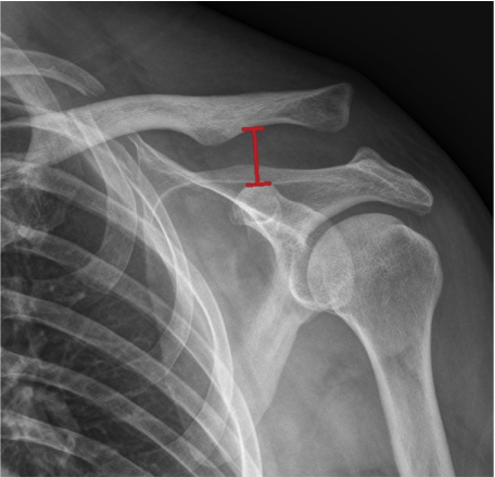 Comparison of clavicular hook plate with and without coracoclavicular suture fixation for acute acromioclavicular joint dislocation