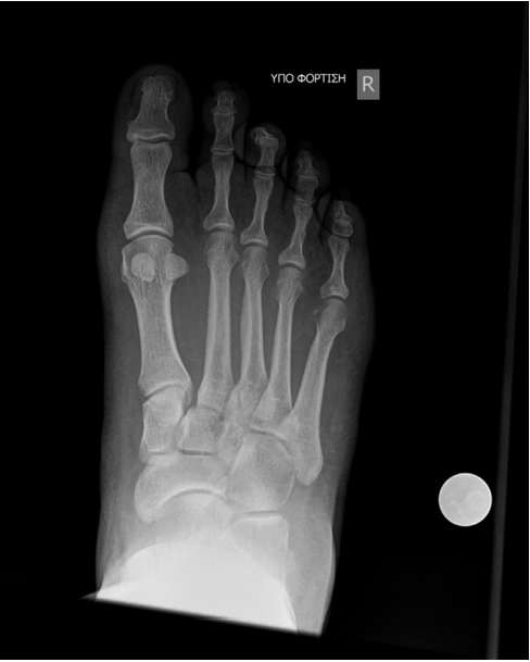 Percutaneous fixation of Lisfranc joint injuries: A systematic review of the literature