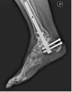 Clinical evaluation of tibiocalcaneal arthrodesis with retrograde intramedullary nail fixation in diabetic patients